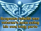 Surgeons rebuild war veteran's nose using his own body parts 