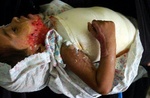 girl_injured_by_us_bombing_150
