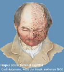 herpes_zoster_150