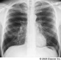 Constrictive bronchiolitis