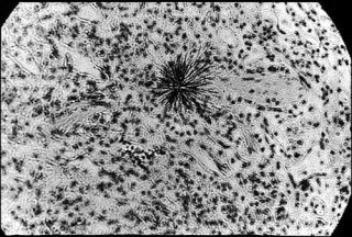 This is your lung on radiation.