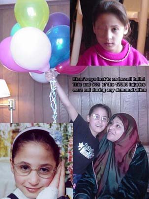 Hiam is one of four Children we brought to CT for treatment. Hiam lost an eye to an Israeli sniper while she walked along a quiet street holding her mother's hand (Gaza; picture in upper right is before prosthetic eye)