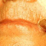 230px-Actinic_keratosis_on_the_lip