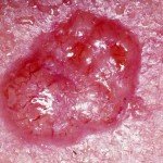 Basal_cell_carcinoma