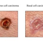Squamous Cell Carcinoma VS Basal Cell Carcinoma