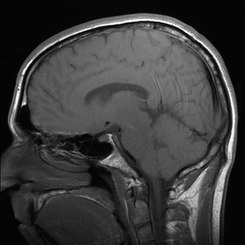 aphasia-