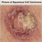 squamous-cell carcinoma