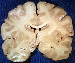tuberous sclerosis-brain