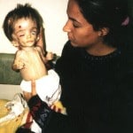Iraq deformed baby