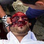 Nabi saleh-Mustafa Tamimi after being shot in the face with a high-velocity tear gas canister from short range -photo Lazar Simeonov