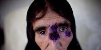 ISIS Spreading ‘Flesh-Eating’ Disease in Syria as a Biologic Weapon