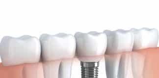 The Fine Art of Taking Care of Your Dental Implants